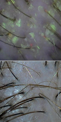 Cabelo oleoso - antes e depois do tratamento