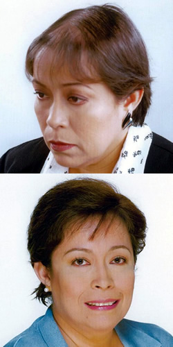 Alopecia feminina - antes e depois do tratamento