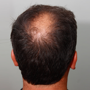 Alopecia androgenética masculina