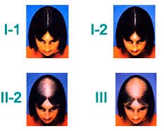 Escala de Ludwig de alopecia feminina