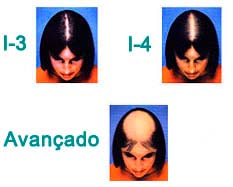 Escala de Ludwig de alopecia feminina